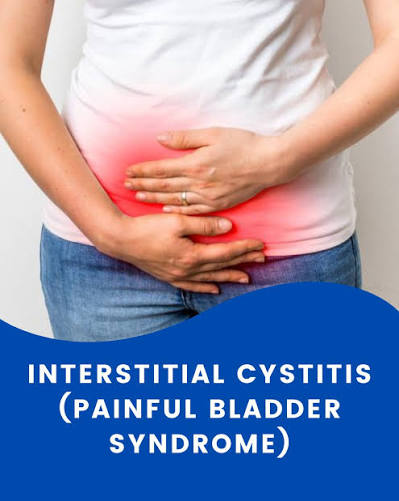 Interstitial Cystitis (IC) Painful Bladder Syndrome Herbal Treatment